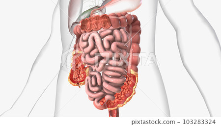 Crohns disease is a type of chronic inflammatory bowel disease. Crohns disease is a type of chronic inflammatory bowel disease. 103283324