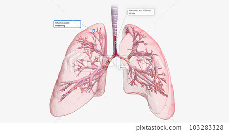 The Narrowed and inflamed airway The Narrowed and inflamed airway 103283328