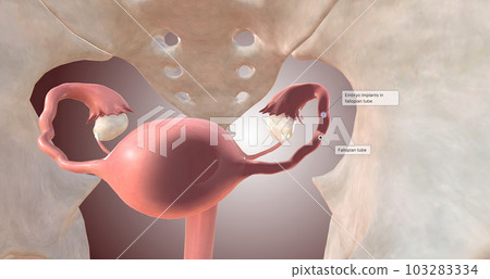 Embryo Implantation in Fallopian Tube 103283334