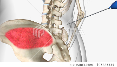 Bone marrow aspiration is a procedure in which a liquid bone marrow sample is collected and tested. Bone marrow aspiration is a procedure in which a liquid bone marrow sample is collected and tested. 103283335