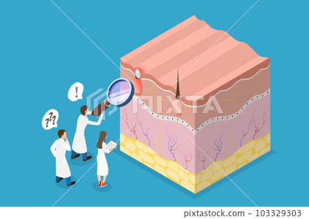 3D Isometric Flat Vector Conceptual Illustration of Acne Vulgari 103329303