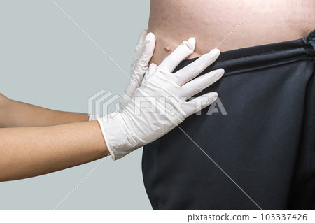 Skin tag or acrochondon or soft fibroma Skin tag or acrochondon or soft fibroma 103337426