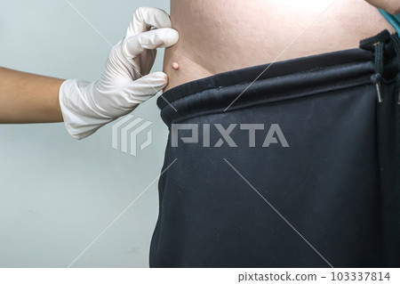 Skin tag or acrochondon or soft fibroma Skin tag or acrochondon or soft fibroma 103337814