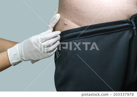 Skin tag or acrochondon or soft fibroma Skin tag or acrochondon or soft fibroma 103337978