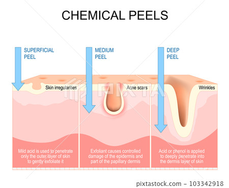 Chemical peels. Exfoliation Chemical peels. Exfoliation 103342918