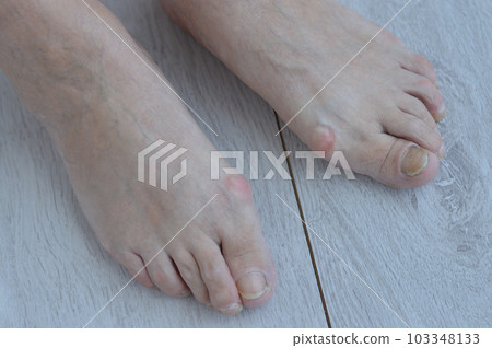 Toe nail with psoriasis and healthy toe nails Psoriatic nail Toe nail with psoriasis and healthy toe nails Psoriatic nail 103348133