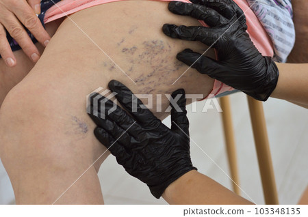 A phlebologist in black gloves conducts a study of veins on the leg of an elderly woman A phlebologist in black gloves conducts a study of veins on the leg of an elderly woman 103348135