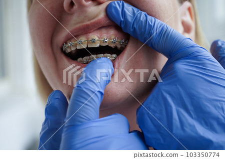 The doctor is examining a female patient with braces. The problem of plaque on teeth during orthodontic treatment. The doctor is examining a female patient with braces. The problem of plaque on teeth during orthodontic treatment. 103350774