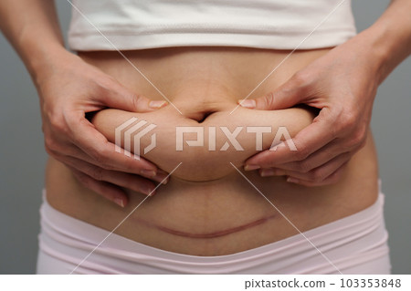 woman grabs and pinches her postpartum belly fat and c-section scar of caesarean 103353848