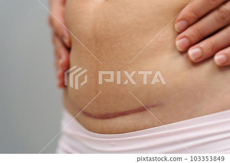 close up belly of woman with c-section scar of caesarean close up belly of woman with c-section scar of caesarean 103353849
