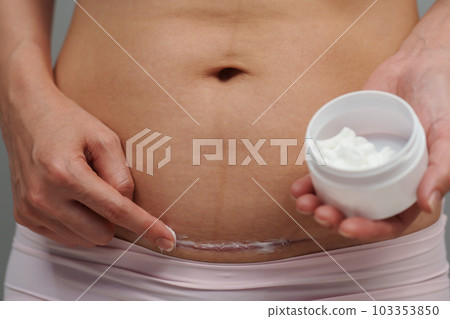 woman putting healing cream in c-section scar of cesarean woman putting healing cream in c-section scar of cesarean 103353850
