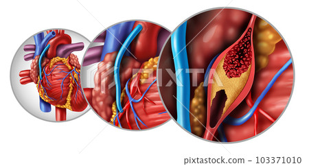 Bypass Surgery 103371010