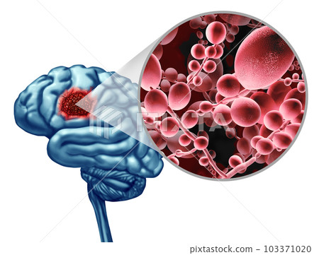 Fungal Brain Infection Fungal Brain Infection 103371020