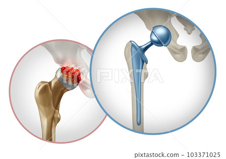 Hip Surgery 103371025