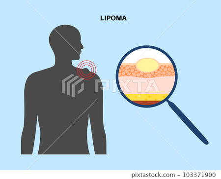 Lipoma medical poster Lipoma medical poster 103371900