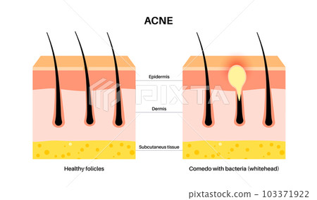 Acne treatment poster 103371922