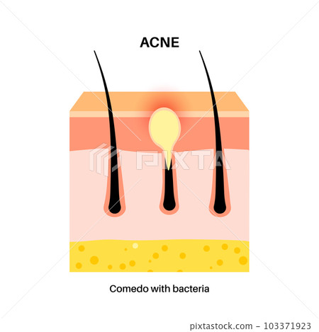 Acne treatment poster 103371923