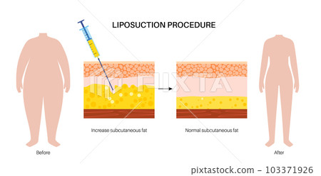 liposuction surgery procedure liposuction surgery procedure 103371926