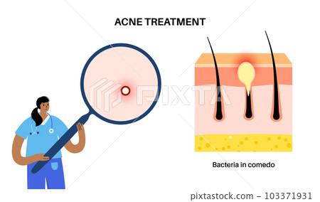 Acne treatment poster 103371931