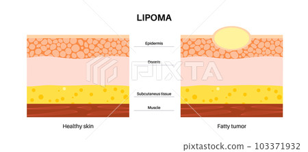 Lipoma medical poster 103371932