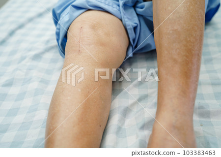 Asian elderly woman patient with scar knee replacement surgery in hospital. Asian elderly woman patient with scar knee replacement surgery in hospital. 103383463