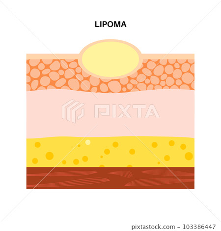 Lipoma medical poster Lipoma medical poster 103386447