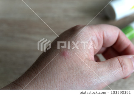 Hand irritation from mosquito bite Hand irritation from mosquito bite 103390391