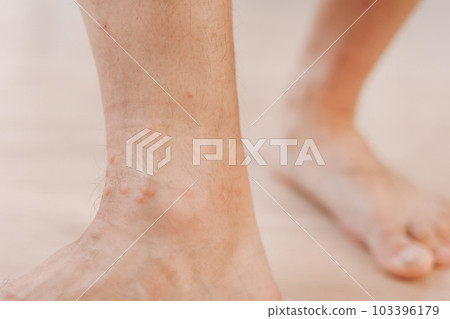 Close up allergic rash dermatitis eczema on man foot. Leg with red rash caused by insect bites. Dermatitis, folliculitis, fungal infection. Affected area of skin to turn red and blotchy and to swell Close up allergic rash dermatitis eczema on man foot. Leg with red rash caused by insect bites. Dermatitis, folliculitis, fungal infection. Affected area of skin to turn red and blotchy and to swell 103396179