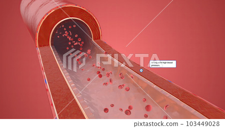 Artery with high blood pressure 103449028