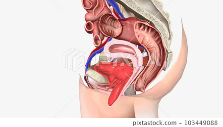 Grade 4 describes a cystocele in which the bulge is entirely past the vaginal opening. Grade 4 describes a cystocele in which the bulge is entirely past the vaginal opening. 103449088