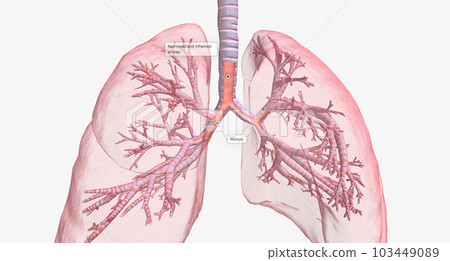 Asthma is a chronic lung disease characterized by inflammation, mucus formation, and narrowing of airways. Asthma is a chronic lung disease characterized by inflammation, mucus formation, and narrowing of airways. 103449089