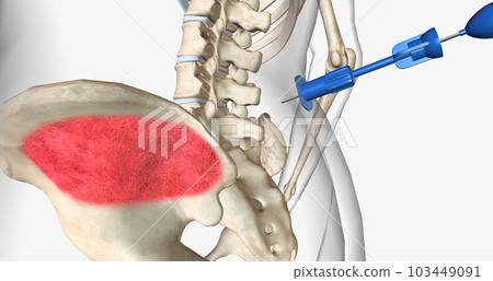 Bone marrow aspiration is a procedure in which a liquid bone marrow sample is collected and tested. Bone marrow aspiration is a procedure in which a liquid bone marrow sample is collected and tested. 103449091