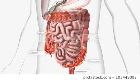 Crohns disease is a type of chronic inflammatory bowel disease. Crohns disease is a type of chronic inflammatory bowel disease. 103449092