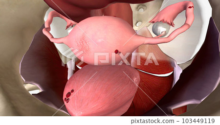 Endometriosis is a condition characterized by the growth of endometrial tissue outside of the uterus. 103449119