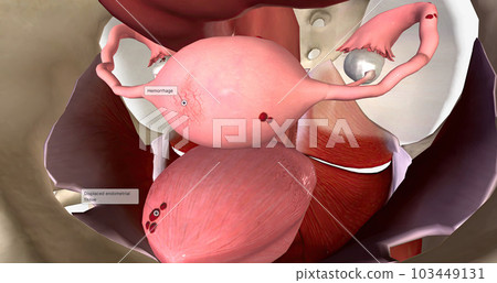 Endometriosis is a condition characterized by the growth of endometrial tissue outside of the uterus. 103449131