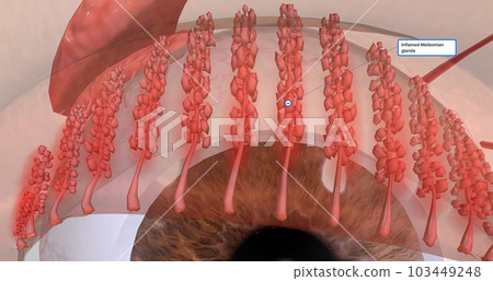 Blepharitis is a chronic inflammation of the eyelids characterized by irritation, redness, watering. Blepharitis is a chronic inflammation of the eyelids characterized by irritation, redness, watering. 103449248