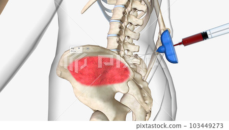 Bone marrow aspiration is a procedure in which a liquid bone marrow sample is collected and tested. Bone marrow aspiration is a procedure in which a liquid bone marrow sample is collected and tested. 103449273