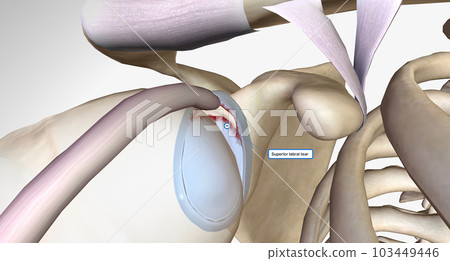 A superior labral tear is when a lesion is found in the upper portion for the labrum. 103449446