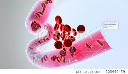Hemophilia is a recessive genetic disorder that impairs the ability of blood to clot. Hemophilia is a recessive genetic disorder that impairs the ability of blood to clot. 103449459