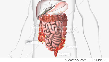 Crohns disease is a type of chronic inflammatory bowel disease. Crohns disease is a type of chronic inflammatory bowel disease. 103449486
