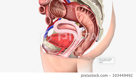 Grade 1 is usually used to describe a rectocele where the rectum has just begun to swell from the back wall of the vagina 103449492