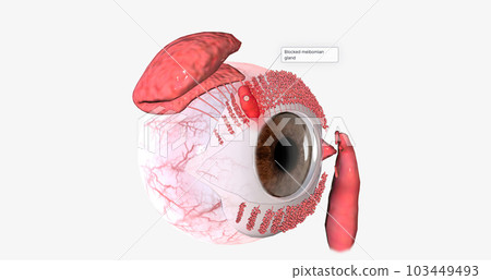 Superficial chalazia form when glands along the edge of the eyelid become infected and blocked. 103449493