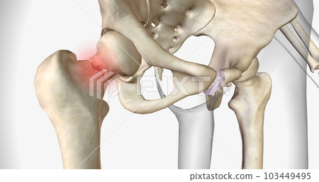 A femoral neck fracture is a type of hip fracture that occurs in the section of the femur closest to the pelvis. 103449495