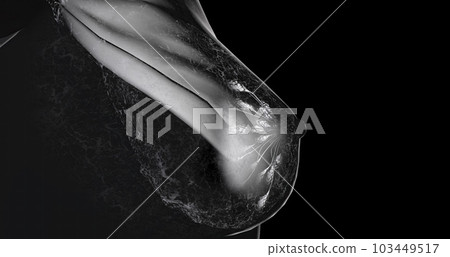 Mammography is a type of X-ray imaging technique used for the screening and diagnosis of breast cancer. 103449517