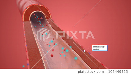 Management of high blood pressure with medication 103449523