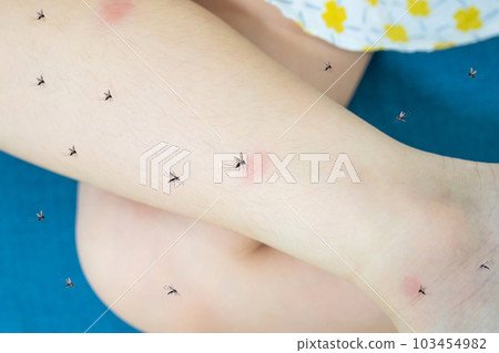 Little girl has skin rash allergy itching on her leg with mosquitoes bite 103454982