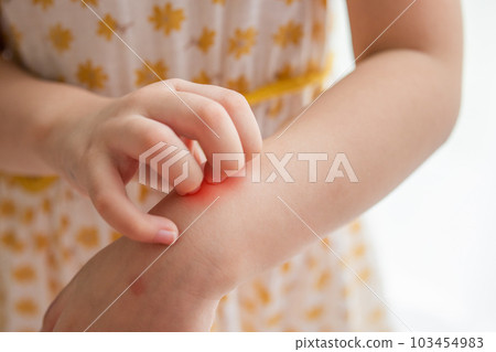 Little girl has skin rash allergy itching and scratching on her arm 103454983