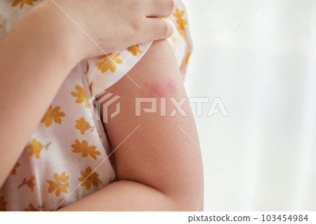 Little girl has skin rash allergy itching and scratching on her arm 103454984