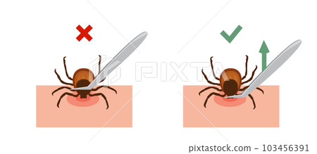 Correct way to remove tick of skin after bite insect correctly, vector illustration. Tips for tick showing safety infographic. Isolated on white background 103456391