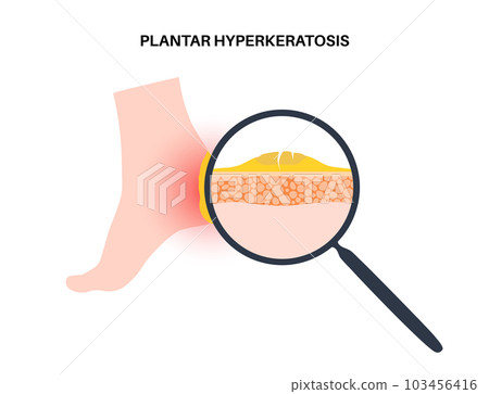 Plantar hyperhidrosis poster 103456416
